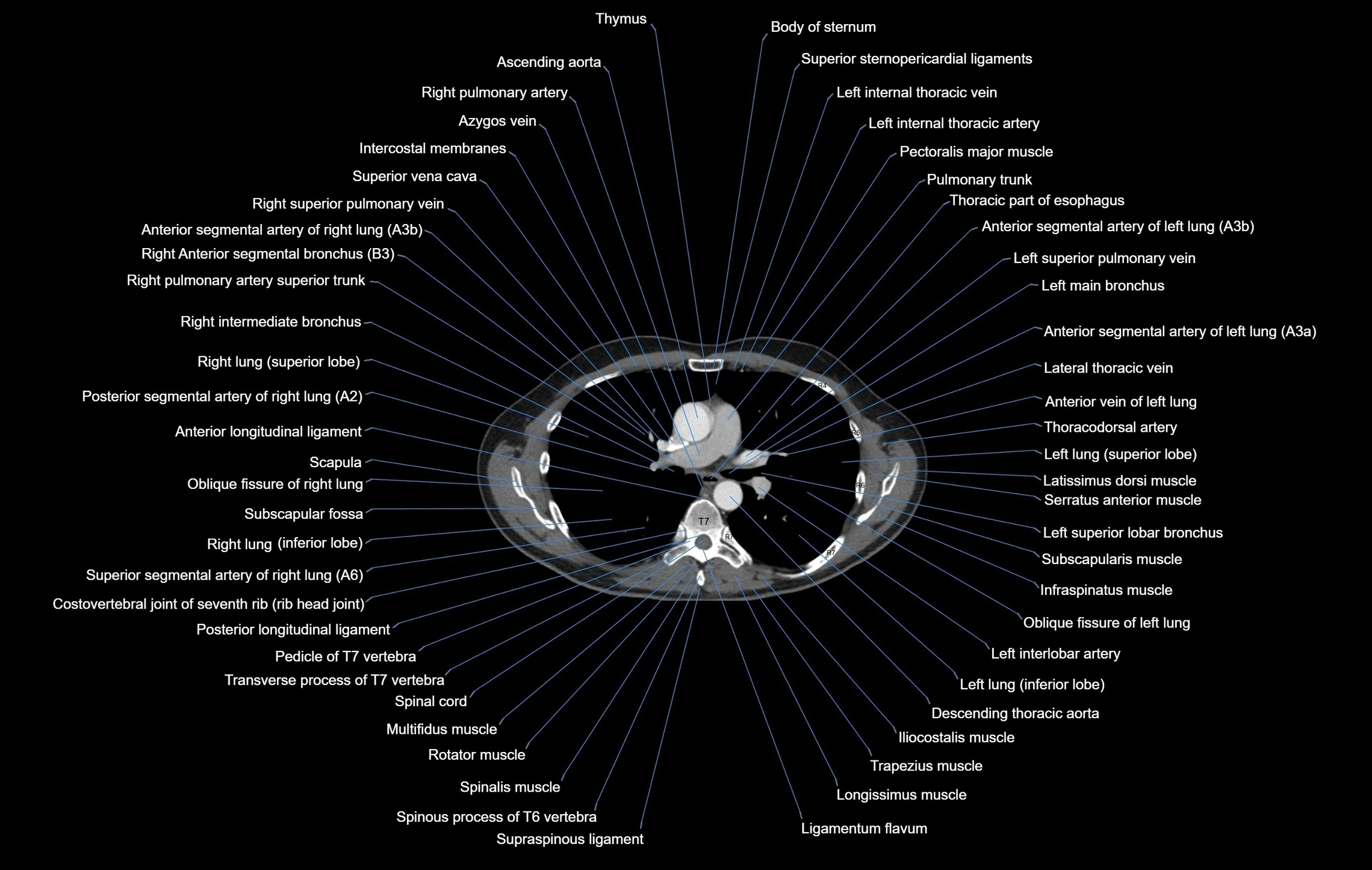 CT chest (thorax) soft tissue window labelled axial cross sectional anatomy radiology image-00056.webp